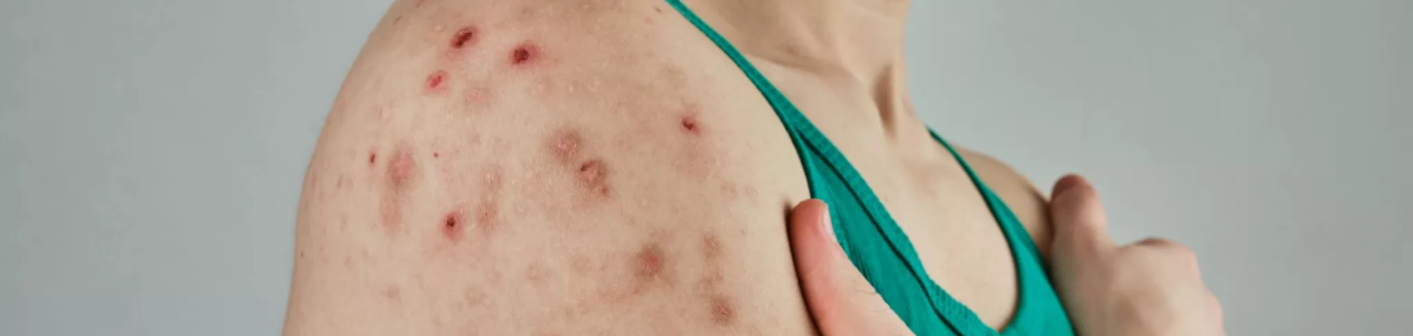 advaya-healing-bodywork_scarwork-ph